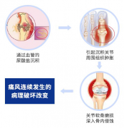 欧美新一代MSUS肌骨超声技术 痛风超声四种征象让